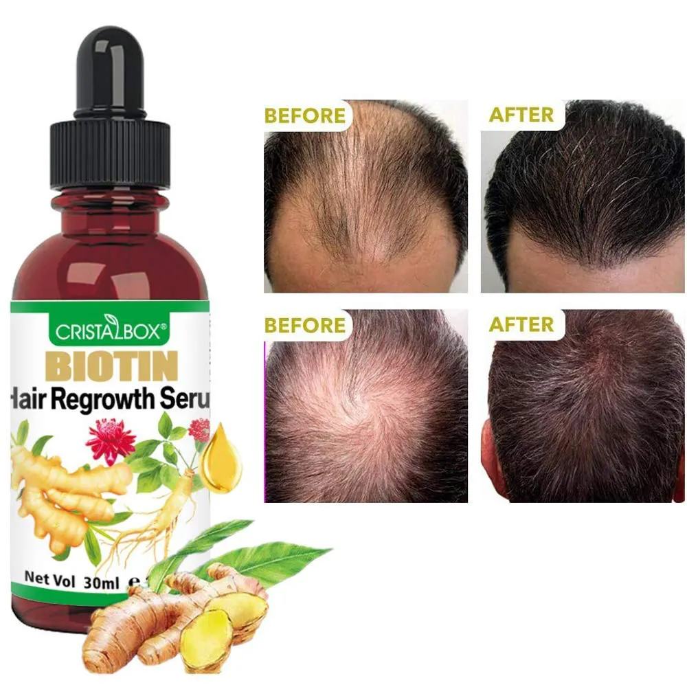 5 PACK Hair Growth Serum,2021 Biotin Hair Growth Oil,Hair Growth Ginger Serum for Men and Women,Hair Growth Treatment,Ginger Oil for Hair Growth,Hair Loss Treatment,Promotes Thicker,Stronger Hair